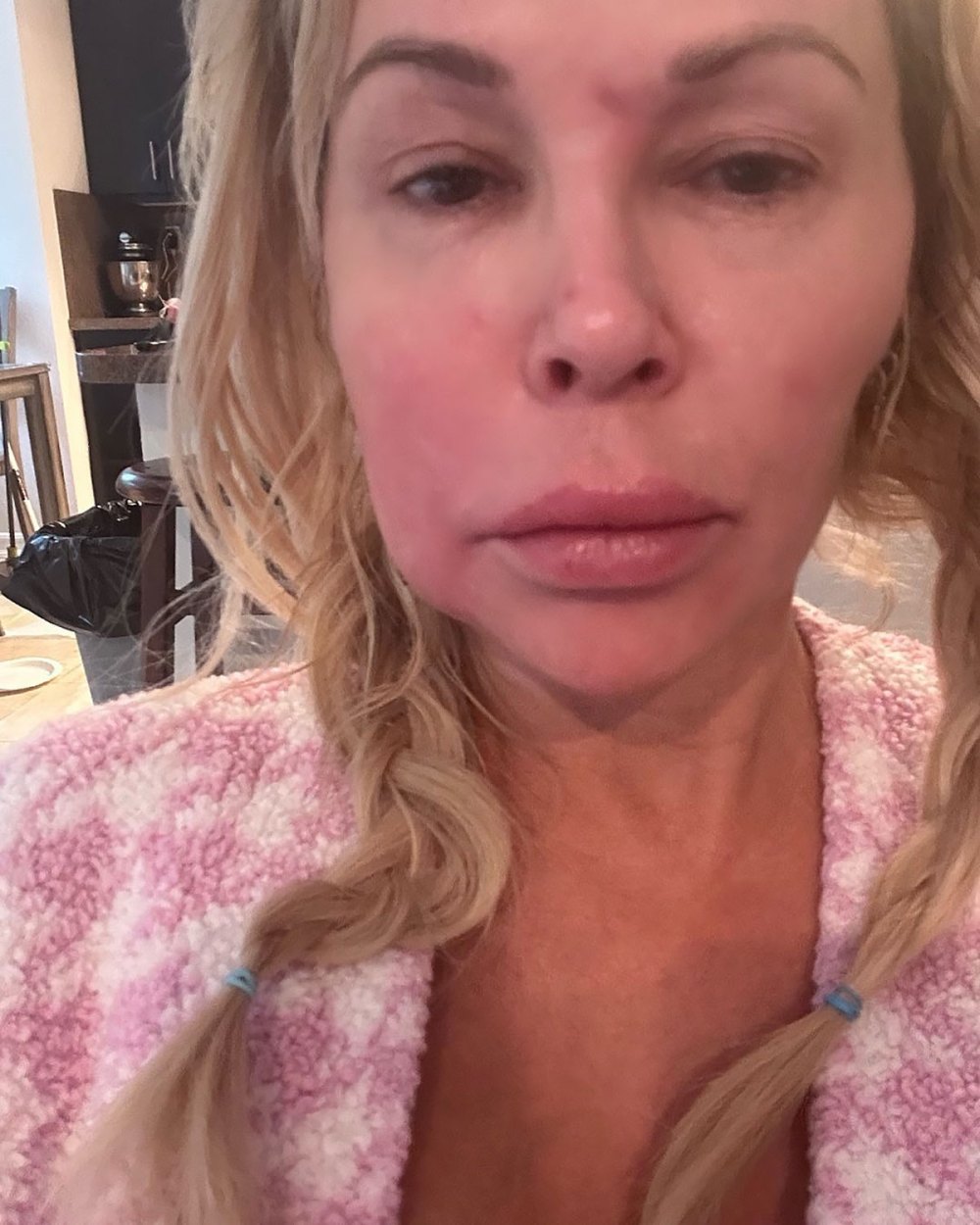 Everything Brandi Glanville Has Said About Her Facial Disfigurement