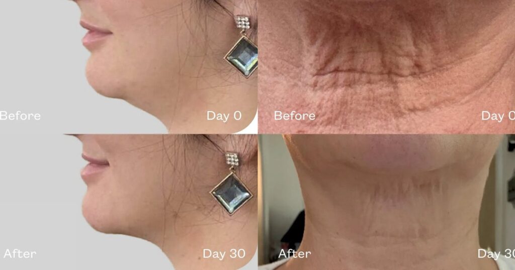 Sagging Jowls? This Serum Sculpts the Jawline and the Neck in Days