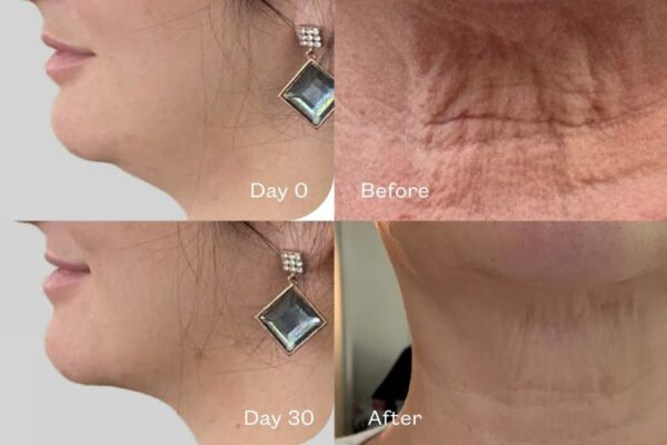 Sagging Jowls? This Serum Sculpts the Jawline and the Neck in Days