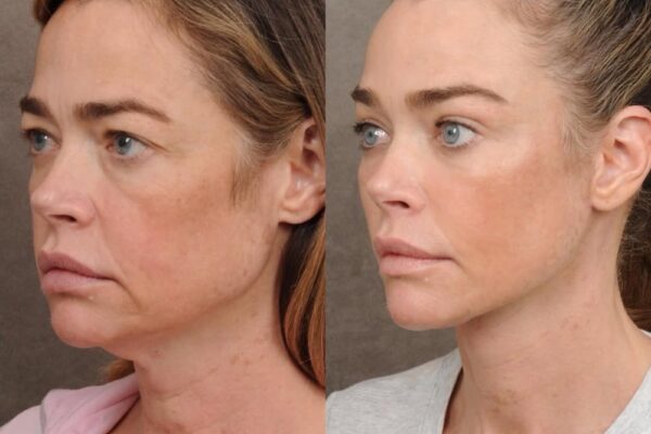 Denise Richards Reveals Jaw-Dropping Before-and-After Facelift Photos