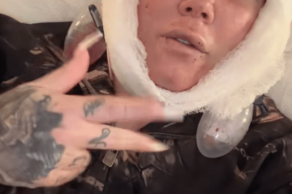 Jelly Roll's Wife Bunnie Xo Reveals Gruesome Aftermath of Her Facelift