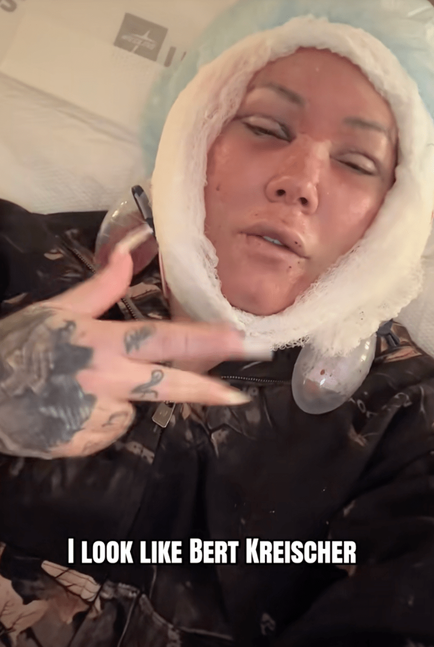 Jelly Roll's Wife Bunnie Xo Reveals Gruesome Aftermath of Her Facelift